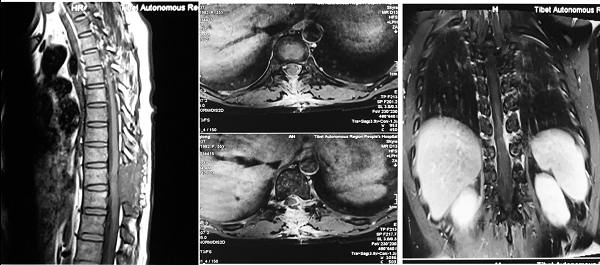 图2  术后胸椎MRI增强.png