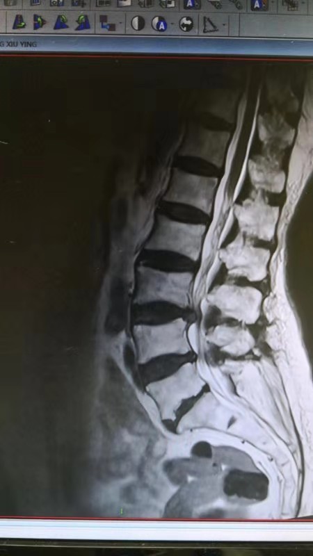 患者术前影像学资料，提示L3-4腰椎间盘突出、腰椎管狭窄1.jpg