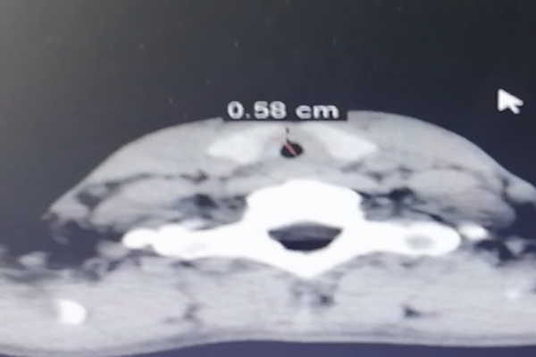 图 1 胸部CT评估气管最狭窄部位为5.8mm_调整大小_调整大小.png