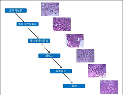胃癌的演变过程.jpg