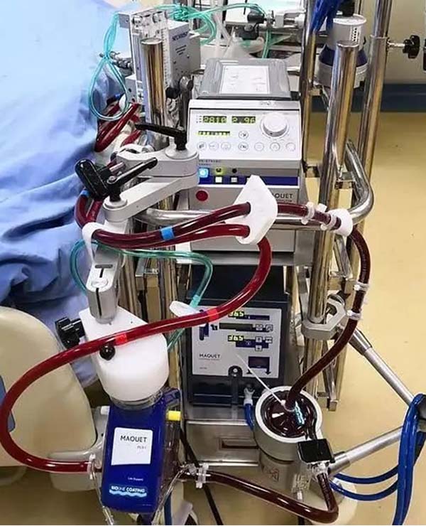 ecmo.jpg