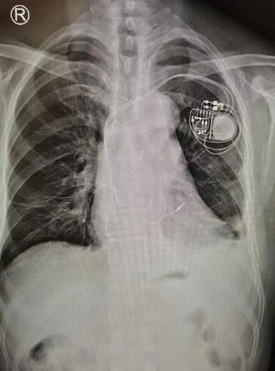 3-术后胸片显示起搏器、电极和二尖瓣成形环，剪头所指为成形环.jpg