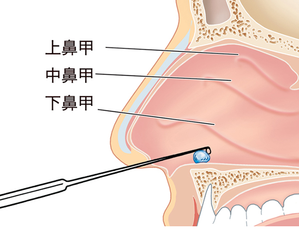 1.-鼻腔异物.jpg