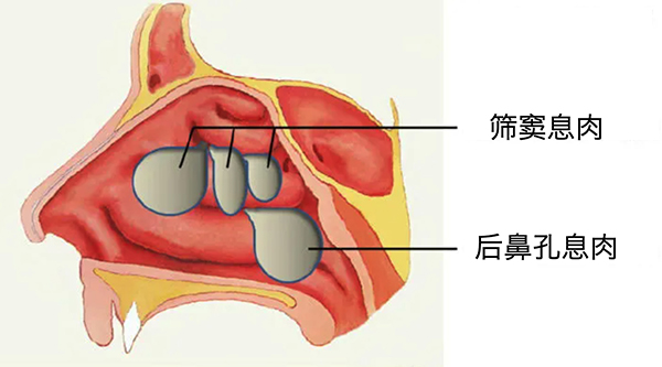 4.-鼻息肉.jpg