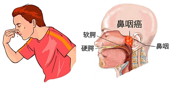 7.-鼻后病变.jpg